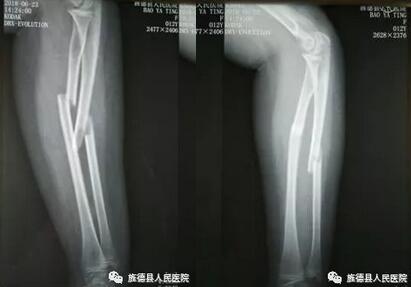 兒童骨折患者的福音---彈性髓內(nèi)釘技術(shù)